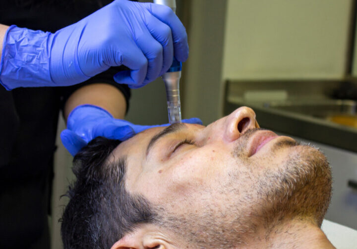 microneedling treatment man