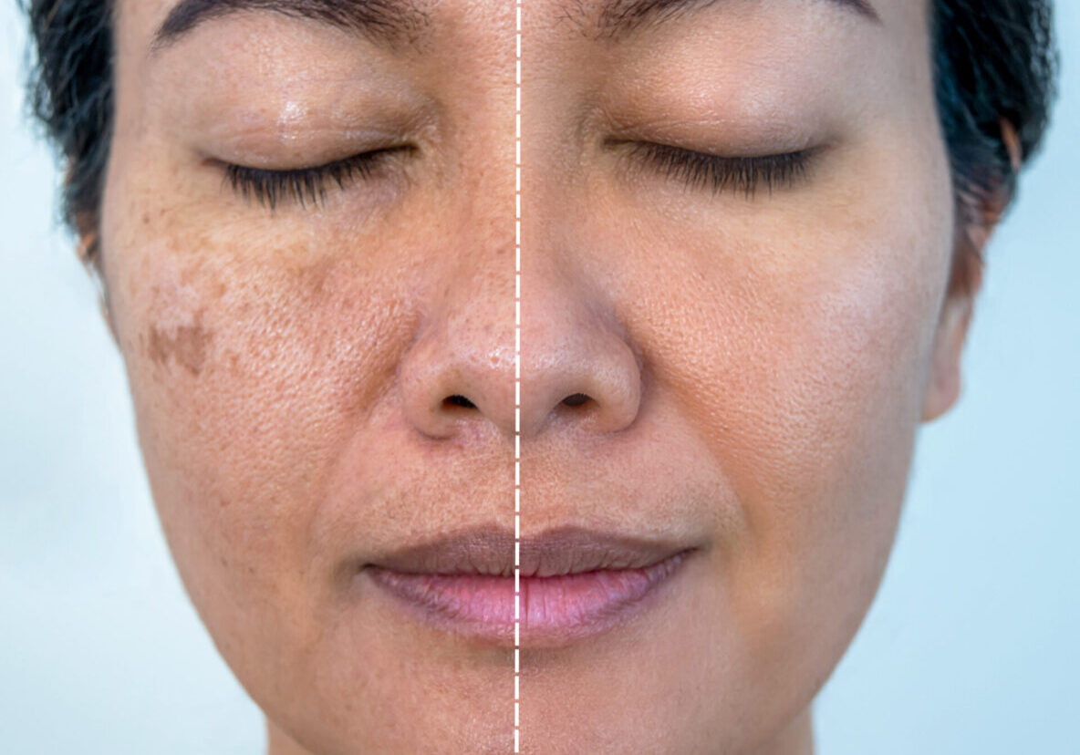 A woman with brown spots on her face and the same person has been corrected.