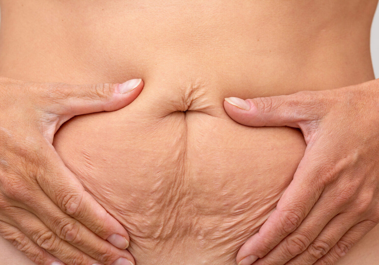 Cropped woman hands on belly pressed skin to show sagging skin after diet and stretch marks after pregnancy